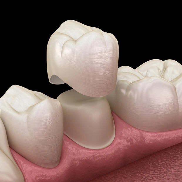 Dental crowns on model teeth and gums showing prosthodontic restoration procedure.