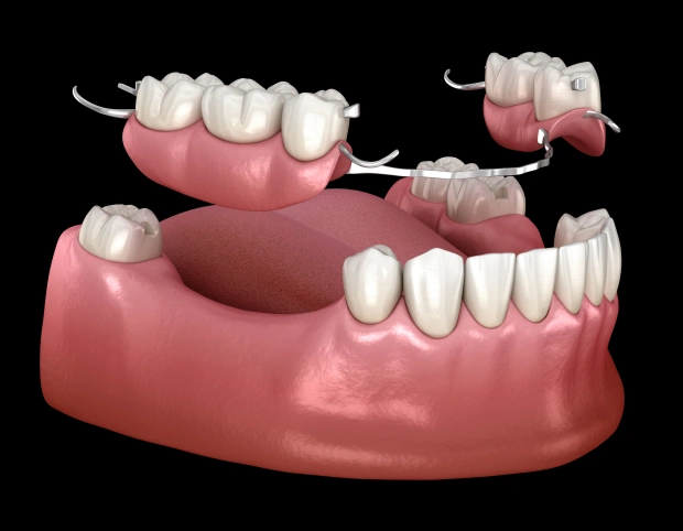 3D dental model showing removable denture prosthetics and tooth implant options on pink gum base.