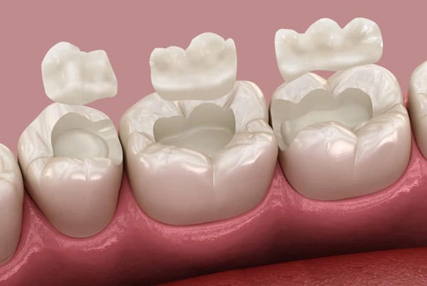 Dental crowns displayed on pink gum model showing restorative tooth procedures.
